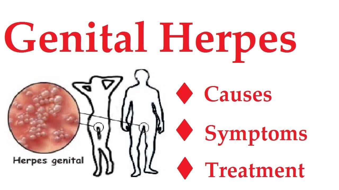 Genital Herpes - What you should know. 1