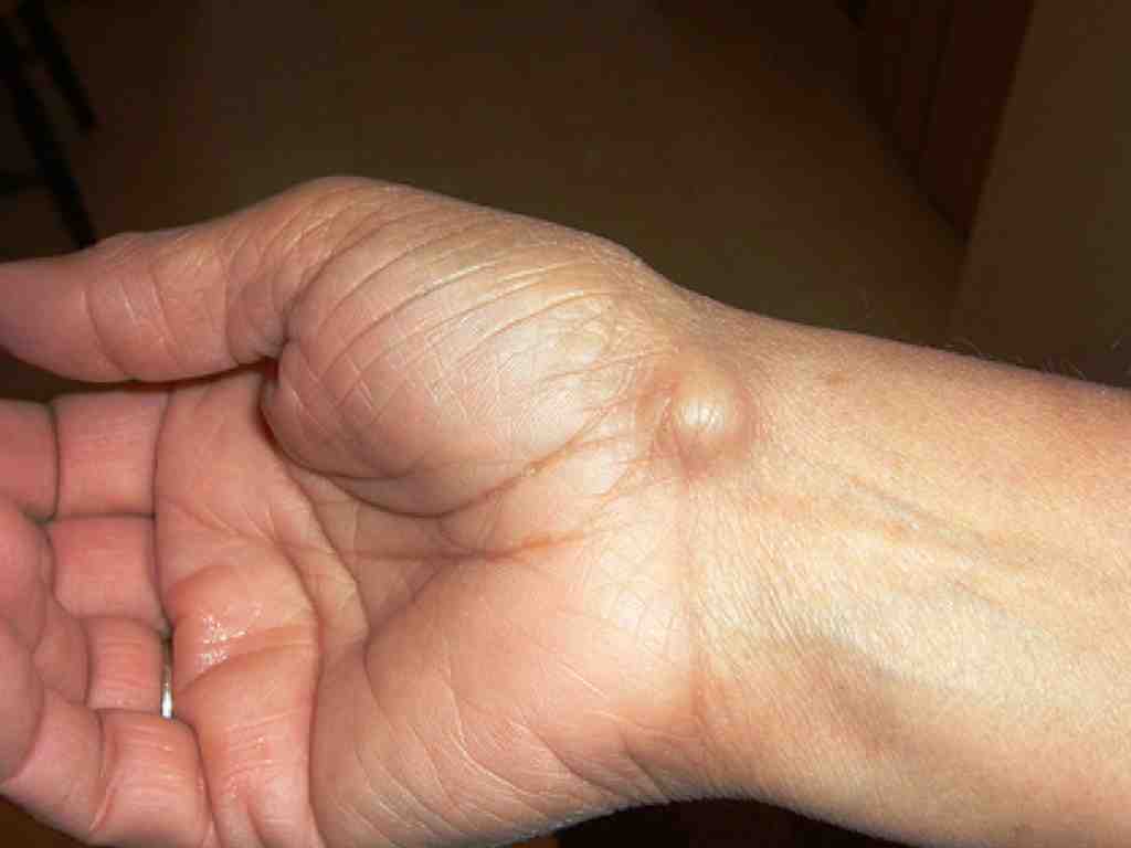 What is a ganglion cyst? 5