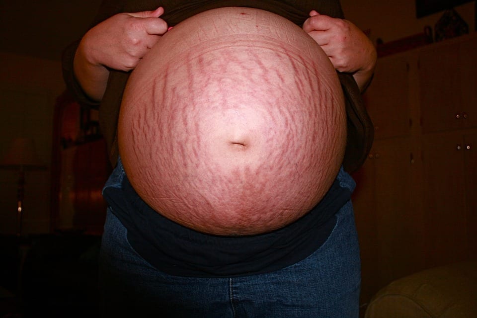 Stretch Marks - Can I prevent them? 3