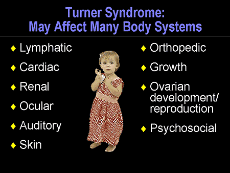 What is Turner?s Syndrome? 4